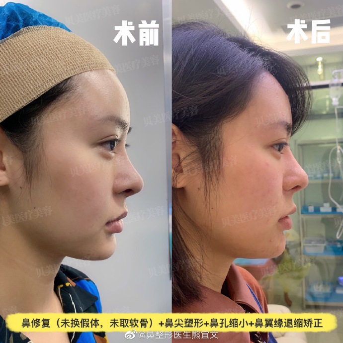 熊宜文鼻修复案例