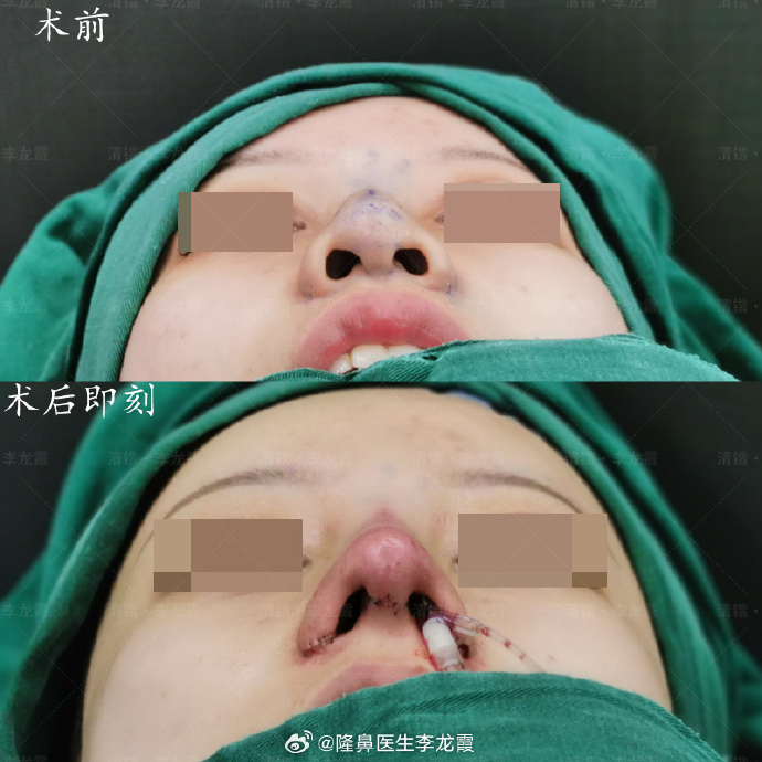 李龙霞鼻修复案例